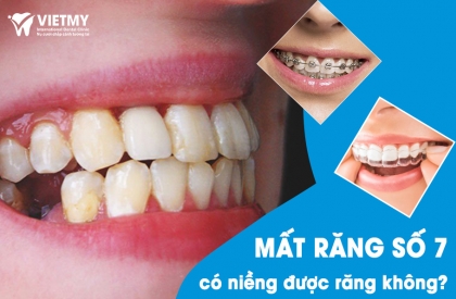 Niềng Răng Khi Mất Răng Số 7: Phương Pháp Niềng Và Quy Trình Điều Trị